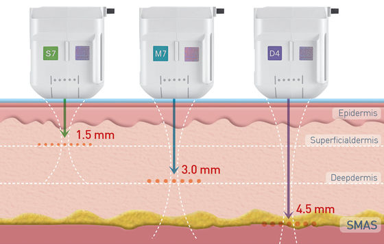 High Intensity Focused Ultrasound HIFU Machine anti-aging Wrinkle Removal SMAS Lifting